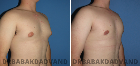 Teen. Before and After Treatment Photos - male - front view (patient - 82)