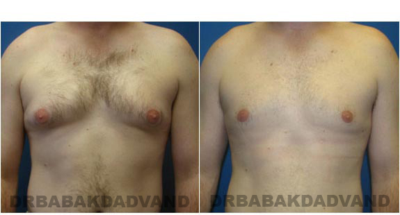 Gynecomastia. Before and After Treatment Photos - male, front view (patient 1)