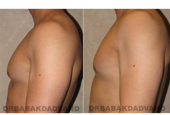 Gynecomastia. Before and After Treatment Photos - male - left side view (patient - 7)