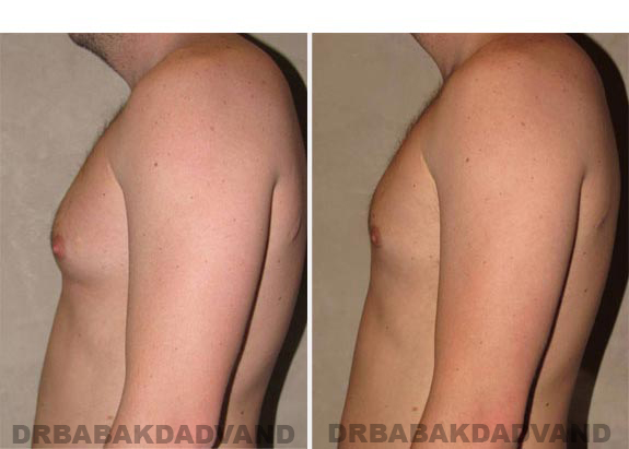 Gynecomastia. Before and After Treatment Photos - male, left side view (patient 14)