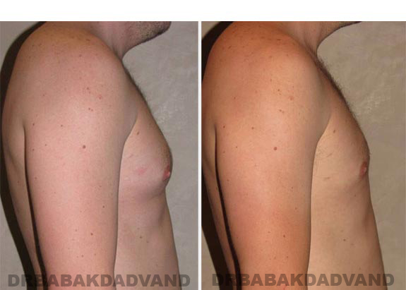 Gynecomastia. Before and After Treatment Photos - male, right side view (patient 14)