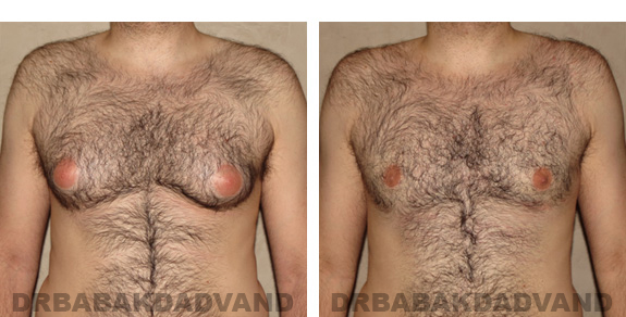 Gynecomastia. Before and After Treatment Photos - male, front view (patient 20)