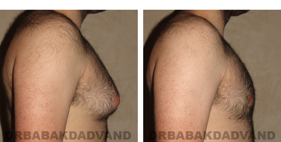 Gynecomastia. Before and After Treatment Photos - male, right side oblique view (patient 20)