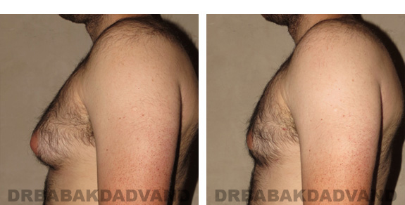 Gynecomastia. Before and After Treatment Photos - male, left side oblique view (patient 20)