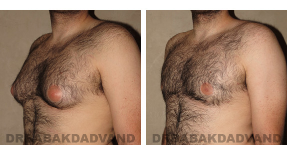 Gynecomastia. Before and After Treatment Photos - male, left side view (patient 20)