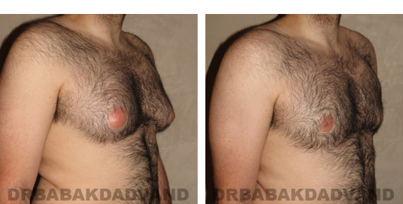 Gynecomastia. Before and After Treatment Photos - male, right side view (patient 20)