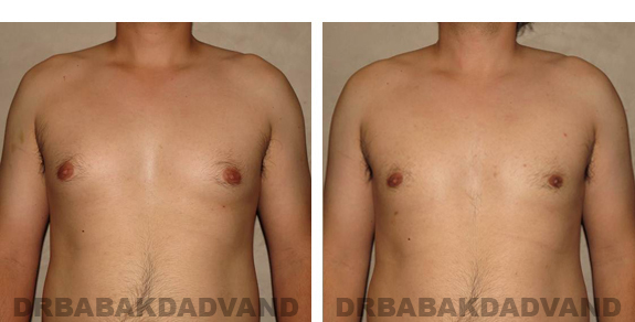 Gynecomastia. Before and After Treatment Photos - male, front view (patient 22)