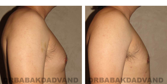 Gynecomastia. Before and After Treatment Photos - male, right side oblique view (patient 22)