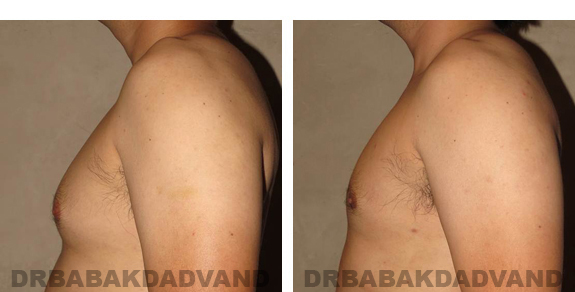 Gynecomastia. Before and After Treatment Photos - male, left side oblique view (patient 22)