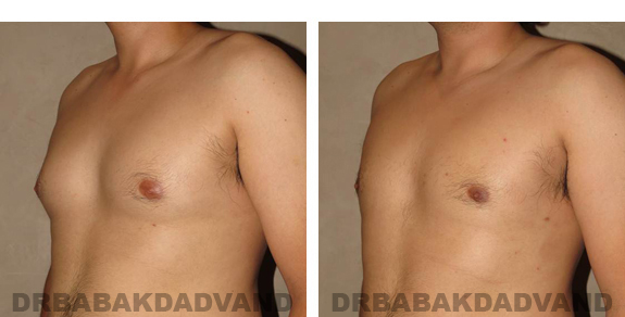 Gynecomastia. Before and After Treatment Photos - male, left side view (patient 22)
