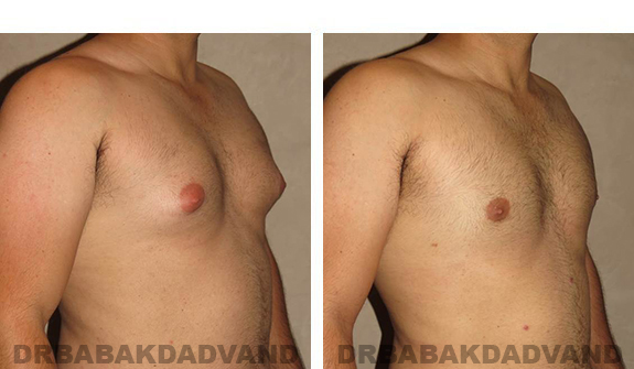 Gynecomastia. Before and After Treatment Photos - male, right side oblique view (patient 27)