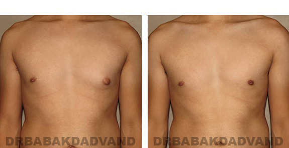 Gynecomastia. Before and After Treatment Photos - male, front view (patient 28)