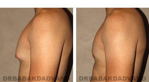 Gynecomastia. Before and After Treatment Photos - male, left side view (patient 29)
