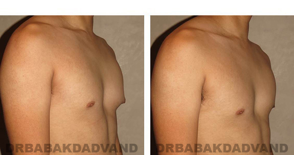 Gynecomastia. Before and After Treatment Photos - male, right side oblique view (patient 29)