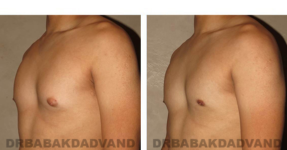 Gynecomastia. Before and After Treatment Photos - male, left side oblique view (patient 29)