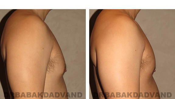 Gynecomastia. Before and After Treatment Photos - male, right oblique view (patient 36)