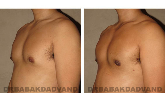 Gynecomastia. Before and After Treatment Photos - male, left side oblique view (patient 36)