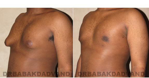Gynecomastia. Before and After Treatment Photos - male, left side oblique view (patient 2)