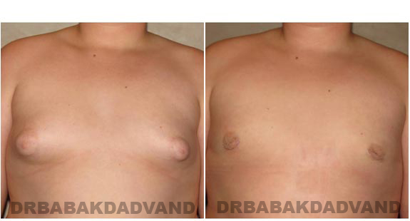 Gynecomastia. Before and After Treatment Photos - male - front view (patient - 6)