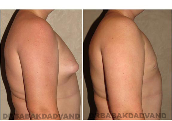 Gynecomastia. Before and After Treatment Photos - male - right side view (patient - 6)