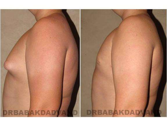 Gynecomastia. Before and After Treatment Photos - male - left side view (patient - 6)
