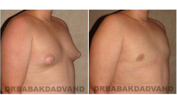 Gynecomastia. Before and After Treatment Photos - male - right side oblique view (patient - 6)