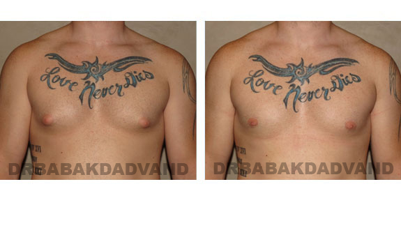 Gynecomastia. Before and After Treatment Photos - male, front view (patient 4)