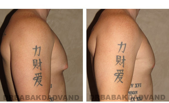 Gynecomastia. Before and After Treatment Photos - male, right side view (patient 4)