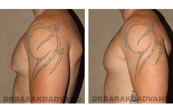 Gynecomastia. Before and After Treatment Photos - male, left side view (patient 4)