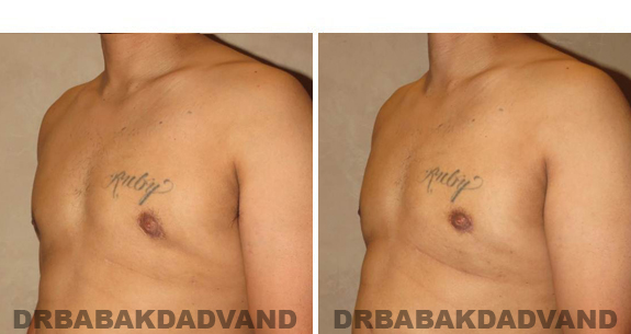 Before and After Treatment Photos - male, left side oblique view (patient 1)