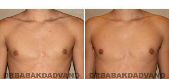 Before and After Treatment Photos - male, frontal view (patient 2)