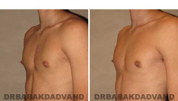 Before and After Treatment Photos - male, left side oblique view (patient 2)