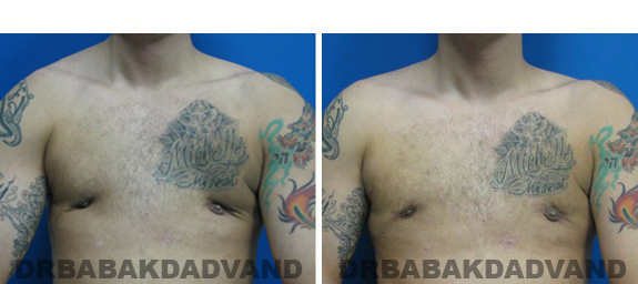Before and After Treatment Photos - male, frontal - view (patient 3)