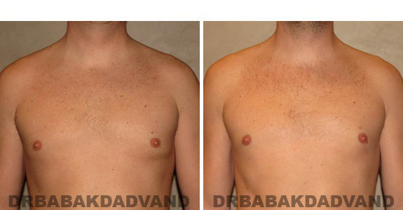 Before and After Treatment Photos - male, frontal view (patient 4)