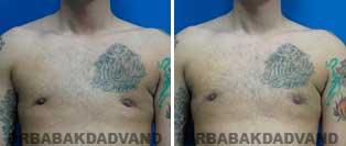 REVISION GYNECOMASTIA. Before and After Photos - Patient 3, 26 year old male