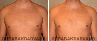 REVISION GYNECOMASTIA. Before and After Photos - Patient 4, 36 year old male