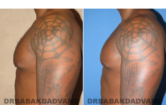 Gynecomastia. Before and After Treatment Photos  - male - left side view (patient 47)