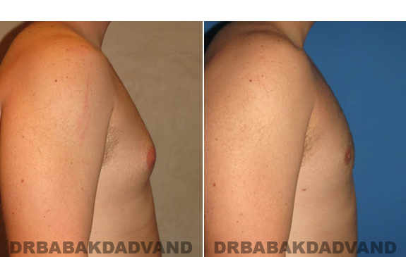 Gynecomastia. Before and After Treatment Photos  - male - right side view (patient 48)