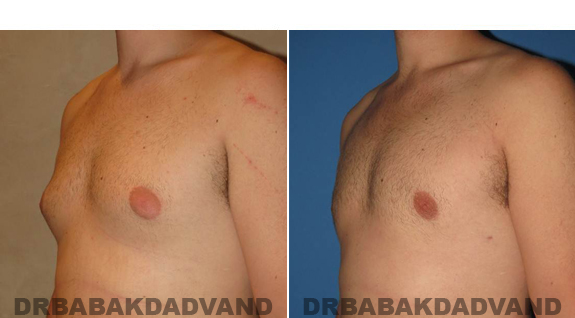 Gynecomastia. Before and After Treatment Photos  - male - left side oblique view (patient 48)