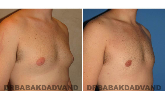 Gynecomastia. Before and After Treatment Photos  - male - right side oblique view (patient 48)