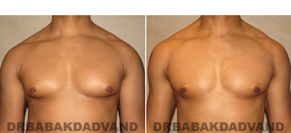 Gynecomastia. Before and After Treatment Photos - male,front view (patient 49)