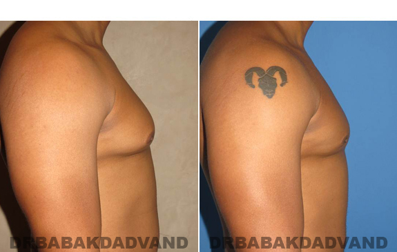 Gynecomastia. Before and After Treatment Photos - male - right side view (patient 49)