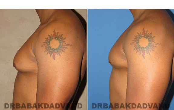 Gynecomastia. Before and After Treatment Photos - male - left side view (patient 49)