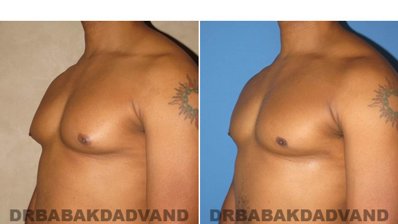 Gynecomastia. Before and After Treatment Photos - male - left side oblique view (patient 49)