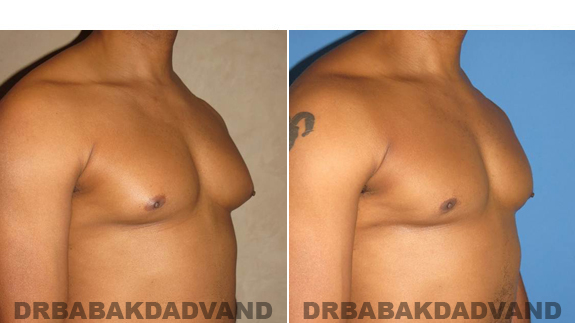 Gynecomastia. Before and After Treatment Photos - male - right side oblique view (patient 49)