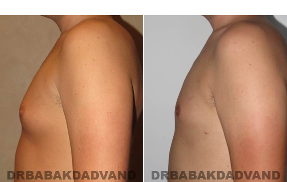 Gynecomastia. Before and After Treatment Photos - male - left side view (patient - 54)