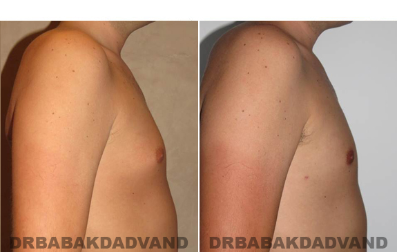 Gynecomastia. Before and After Treatment Photos - male - right side view (patient - 54)