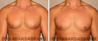 Before and After Treatment Photos: 28 year old Male, puffy nippels