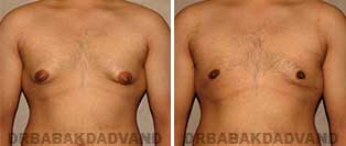 Before and After Treatment Photos: 23 year old male, gynecomastia surgery