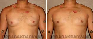 Before and After Treatment Photos: gynecomastia surgery - 34 year old patient